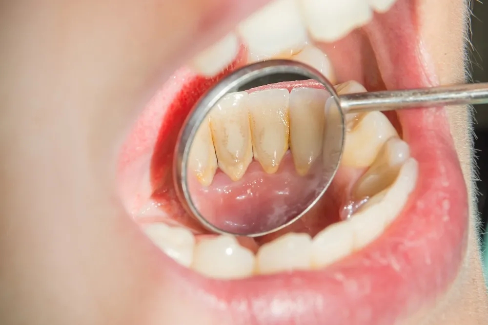 为什么有的人，牙结石长在牙龈下面？