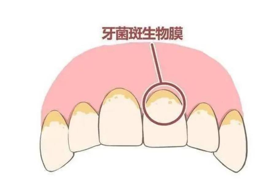 牙齿烂到牙神经，究竟需要多久？