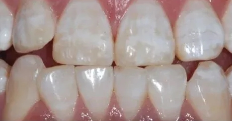 所谓的氟斑牙，到底是怎么来的？